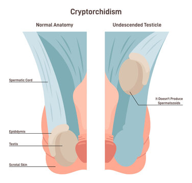 Cryptorchidism. Absence of one or both testes from the scrotum.