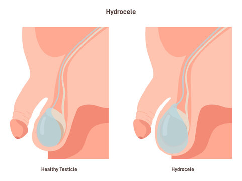 Hydrocele. Swelling in the scrotum. Accumulation of serous fluid