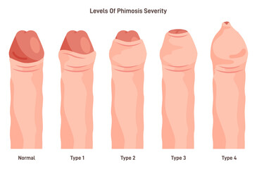 Types of phimosis. Inability to retract the foreskin covering the head