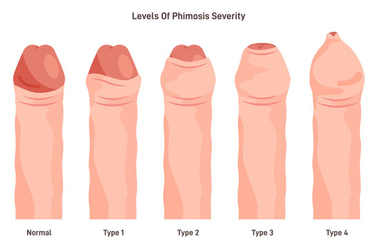 Types of phimosis. Inability to retract the foreskin covering the head