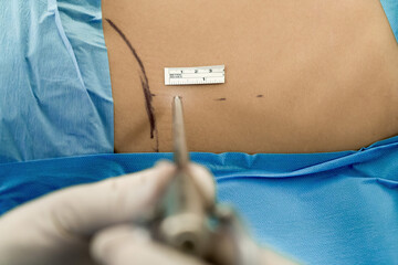 Before the spinal surgery operation, the patient is measured and adjusted with a surgical meter.