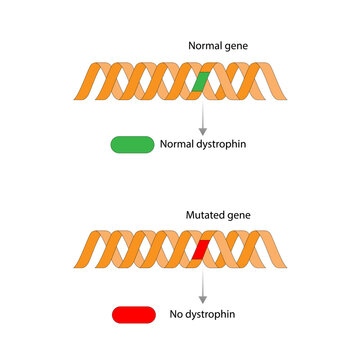 Muscular dystrophy ,MD, Duchenne MD syndrome, mutations in genes responsible for healthy muscle structure and function. Vector illustration.
