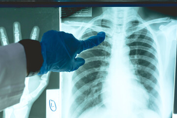 A female radiologist checks the x-ray plates of the ribs of a patient for potential hairline...