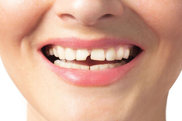 Woman smiles with broken tooth. Need a Dentist. Close up photo white background.