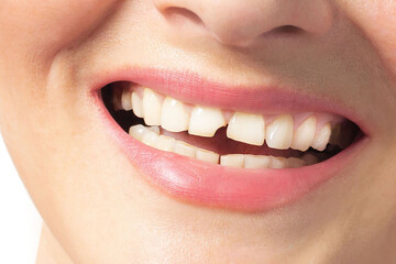 Woman smiles with broken tooth. Need a Dentist. Close up photo white background.