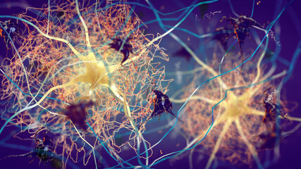 Fototapeta na wymiar Beta-amyloid protein disrupting nerve cells function in a brain with Alzheimer's disease. Amyloid plaques forming between neurons. 