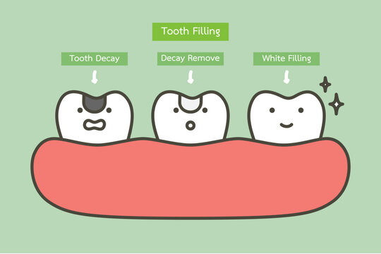 step of tooth amalgam filling by dental tools to protection decay tooth, before and after - teeth cartoon vector flat style