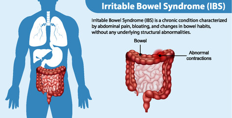 Irritable Bowel Syndrome (IBS) Infographic