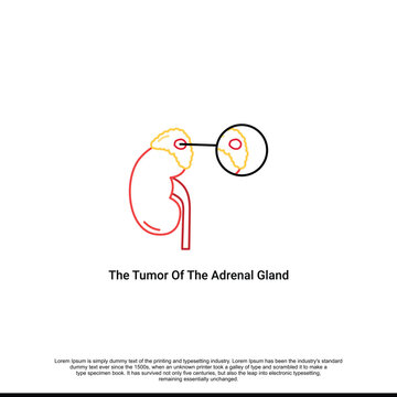 A tumor of the adrenal gland. Structure of the kidneys. Vector illustration on isolated background