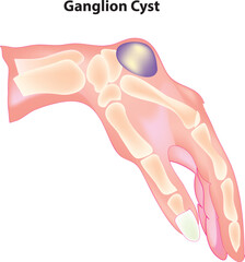 ganglion cyst (lumps that most often appear along the tendons or joints of wrists or hands)