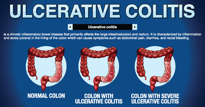 Ulcerative Colitis Symptoms Infographic