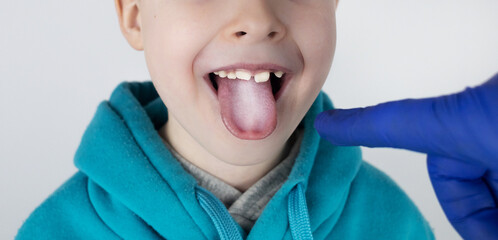 Blond boy has a white tongue. Painful white coating on the mucous membrane of the tongue. Diseases...