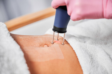 Close-up view of skin abdomen immediately after treatment with carbon dioxide laser. Laser device...