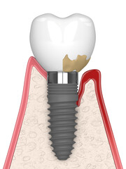 3d render of healthy implant versus implant with peri implantitis