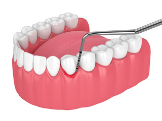 3d render of human jaw with peri implantitis disease and periodontal sonda - obrazy, fototapety, plakaty