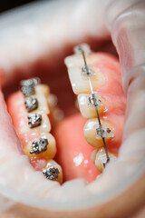 Close-up of teeth with metal braces. Orthodontic treatment of the jaw