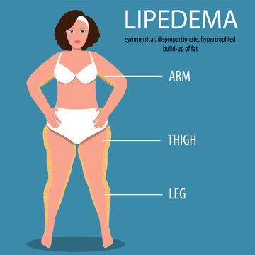 Lipedema Images – Browse 293 Stock Photos, Vectors, and Video