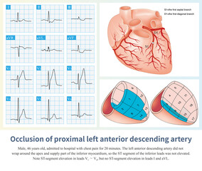 After the first diagonal branch and before the first septal branch of the LAD were occluded, the infarction affected the anteroseptum, and the high lateral wall was not affected.