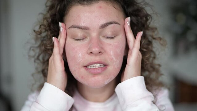 Young beautiful woman with akne skin making home beauty tretment