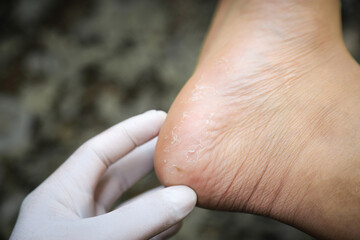 Doctor hand checking Pitted Keratolysis on foot of man in treatment of health care living life