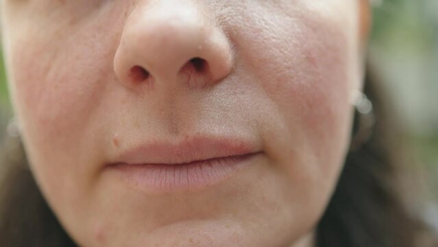 close-up herpes sores on upper lip female face. herpes simplex pimples bumps with liquid. herpes clusters primarily observed in bunch on woman lips face. virus cold flu effects health immune 