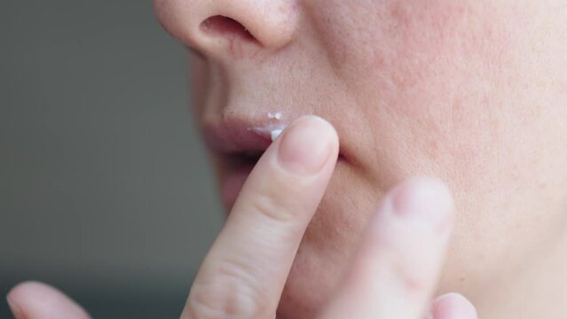 applying ointment on herpes simplex pus-filled blisters bumps. female apply white cream on upper lip sore vesicles on face. touching lip with herpes virus ulcers close-up
