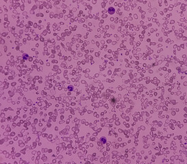 Hereditary hemolytic anemia.  Smear show hypochromia and anisopoikilocytosis, target cell, tear drop cell, schistocytes and spherocytes.