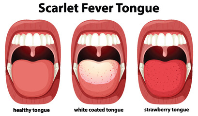 Scarlet fever tongue symptoms