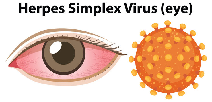 Herpes simplex virus (Eye)