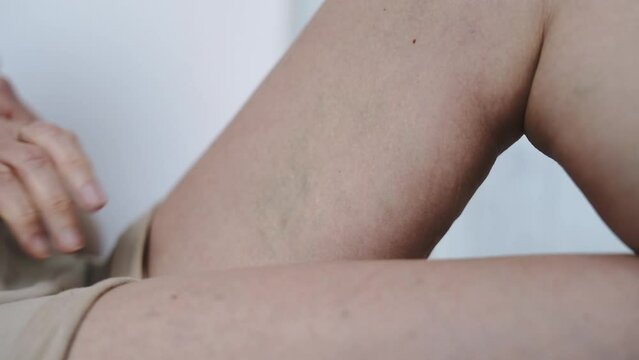 Mature woman legs close-up with varicose veins problem