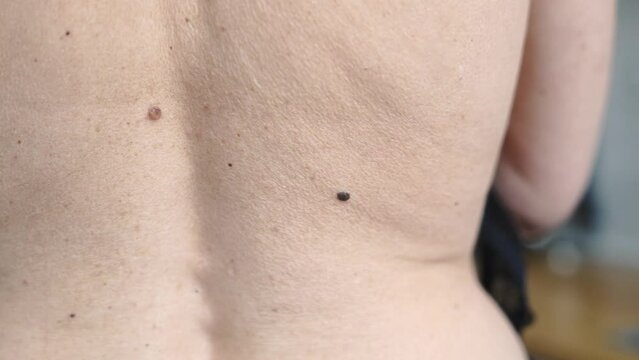Mature woman mole on skin back. dermatology problem 