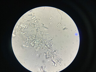 Microscopic view of struvite crystals from urinary sediment. Magnesium ammonium phospate crystals....