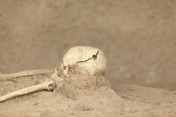 Trepanned skeleton with surgery intervention skull burr hole