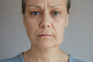 Portrait of a mature sad woman with a swelling on her cheek.