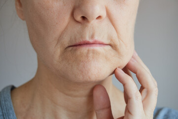 Fototapeta premium Close-up of a mature woman with swelling on her cheek, toothache
