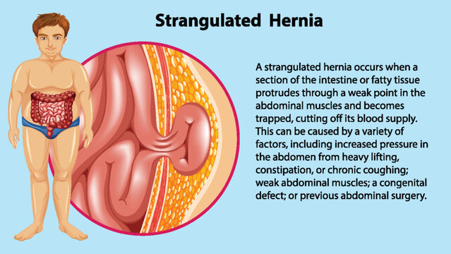 Causes of Strangulated Hernia Infographic