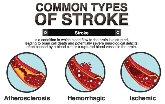 Informative poster of common types of stoke