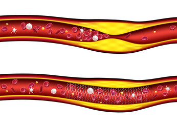 3D illustrations before and after stenting improve blood flow, atherosclerosis. medical use education and science