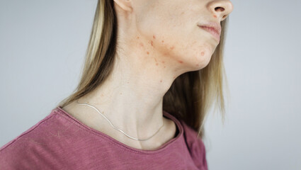 Girl shows acne on her face. Acne on the neck. Demodicosis on the chin. Redness and rash on the...