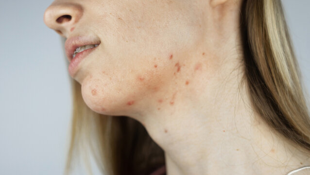 Girl shows acne on her face. Acne on the neck. Demodicosis on the chin. Redness and rash on the woman face. Acne and redness treatment. Large blisters, pits and enlarged pores