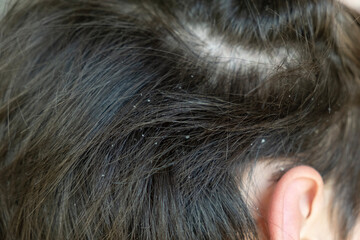 Dandruff in kid hair. Flaky scalp. Children's dandruff. Seborrheic dermatitis. White scales on the...
