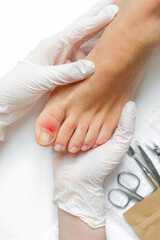 Naklejka na ściany i meble Pedicure, podologist. Patient on medical pedicure procedure, nail disease, cholesis detachment of the nail plate. Foot care, treatment in a medical spa salon.