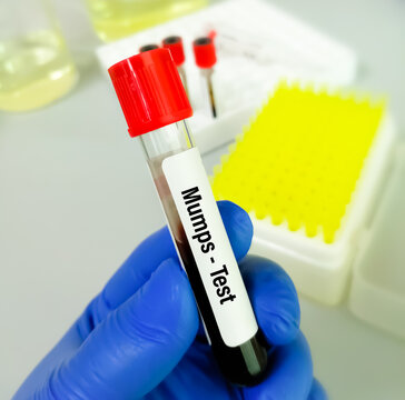 Mumps Test, blood sample in infection lab