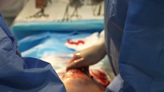 The process of removing a baby from the uterus by caesarean section. Caesarean section operation close-up. Variable focus. High quality 4k footage