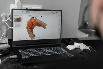 Dentistry 3D scan of the patient's teeth on the screen