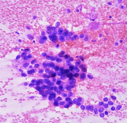 Photomicrograph of fine needle aspiration (FNA) cytology of a pulmonary (lung) nodule showing adenocarcinoma, a type of non small cell carcinoma.