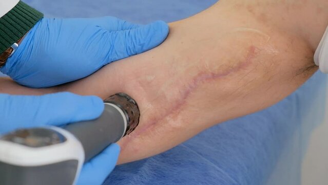 The doctor, using shock wave therapy equipment, performs a procedure on the left arm of a male patient. Postoperative rehabilitation of the patient. Close-up.
