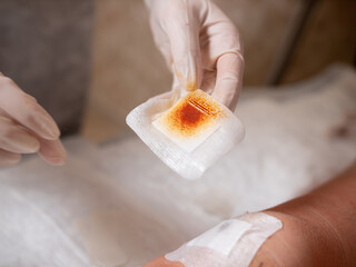 Close-up of a sterile patch with iodine solution.