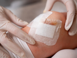 Close-up of female hands of a nurse in sterile gloves at the knee of a patient after arthroscopy surgery.