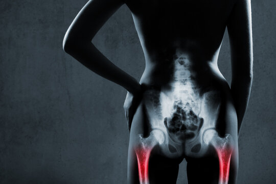 Human femur in x-ray on gray background. Painful femurs is highlighted by red color. X-ray image of painful thigh-bones in woman. Thigh-bones at red area mark.